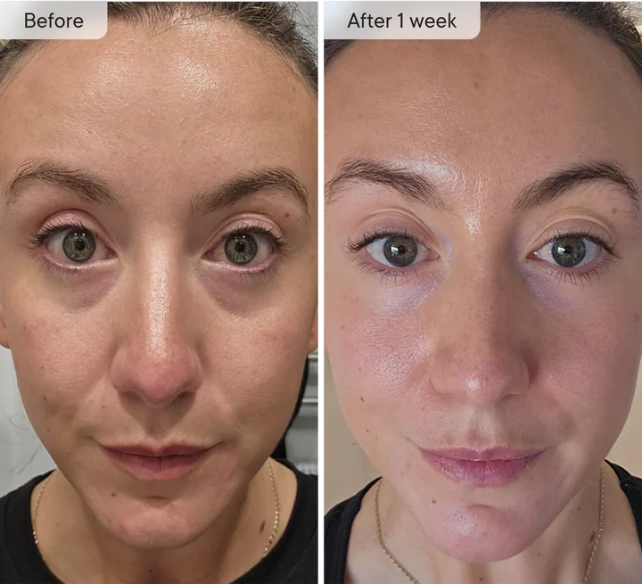 Manhattan Ice - K Beauty Micro Needle Under Eye Patches