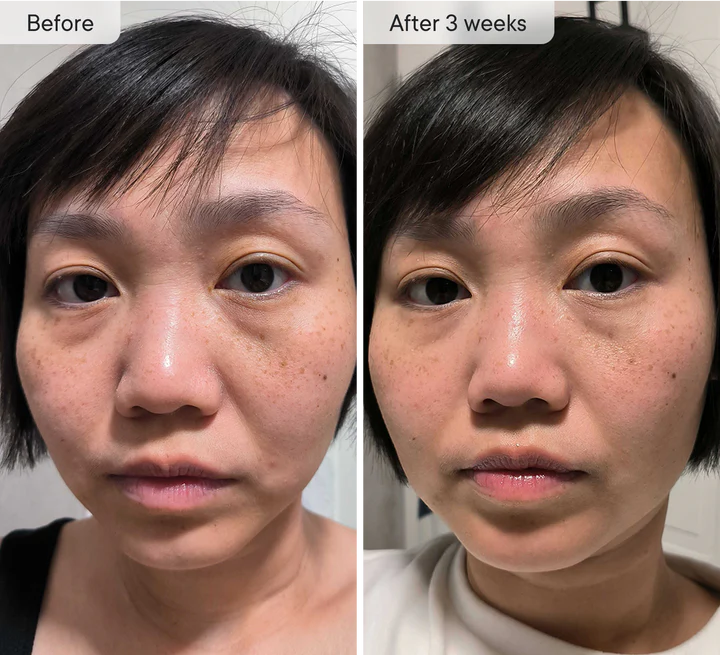 Manhattan Ice - K Beauty Micro Needle Under Eye Patches