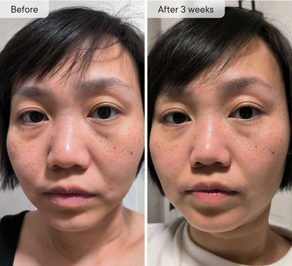 Manhattan Ice - K Beauty Micro Needle Under Eye Patches