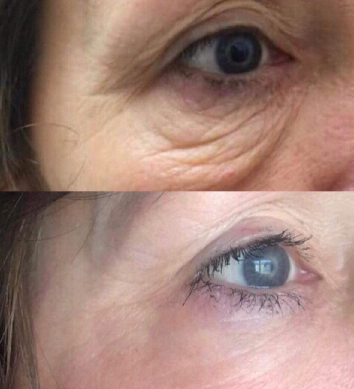 Manhattan Ice - K Beauty Micro Needle Under Eye Patches