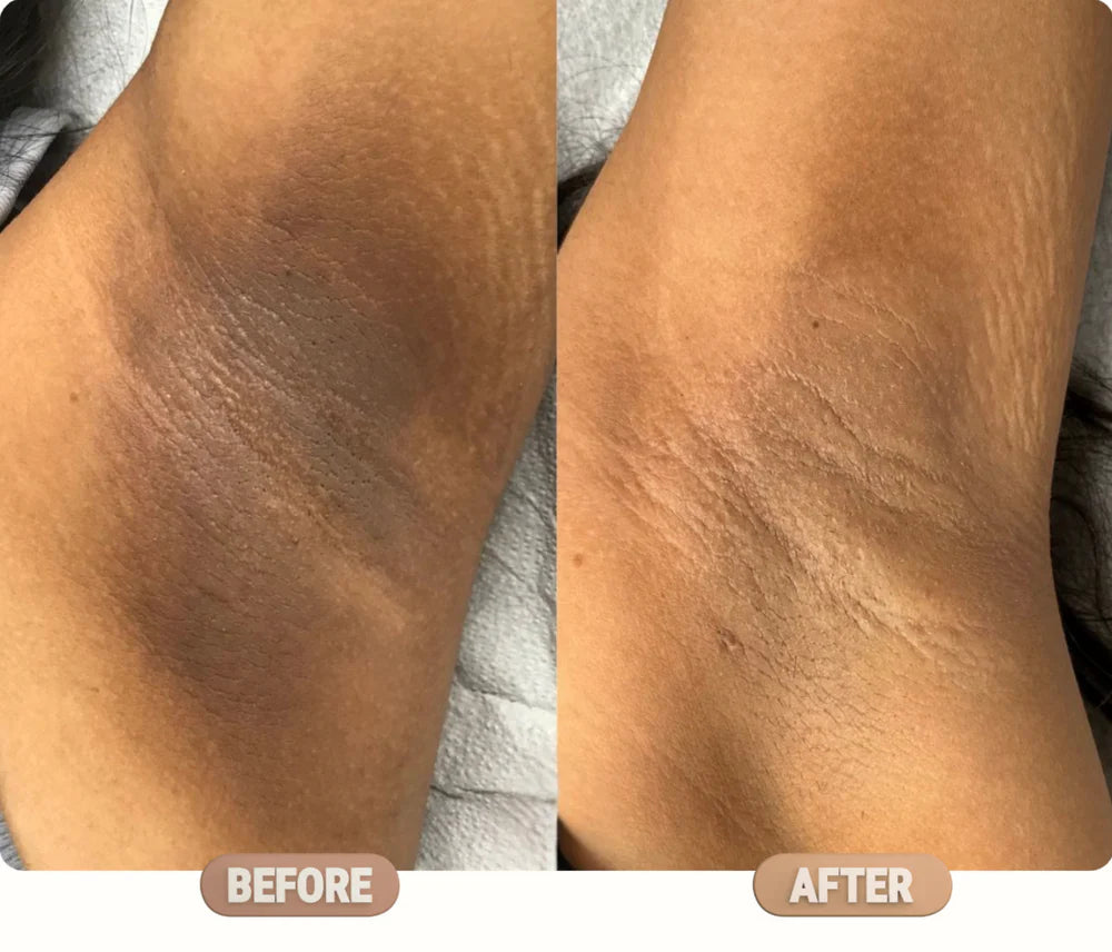 Manhattan Ice Kojic Acid Spray + Free Gift