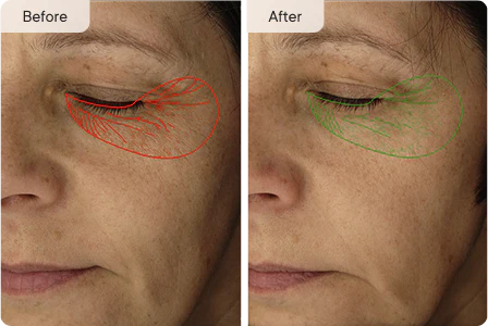 Manhattan Ice - K Beauty Micro Needle Under Eye Patches