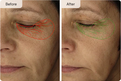 Manhattan Ice - K Beauty Micro Needle Under Eye Patches