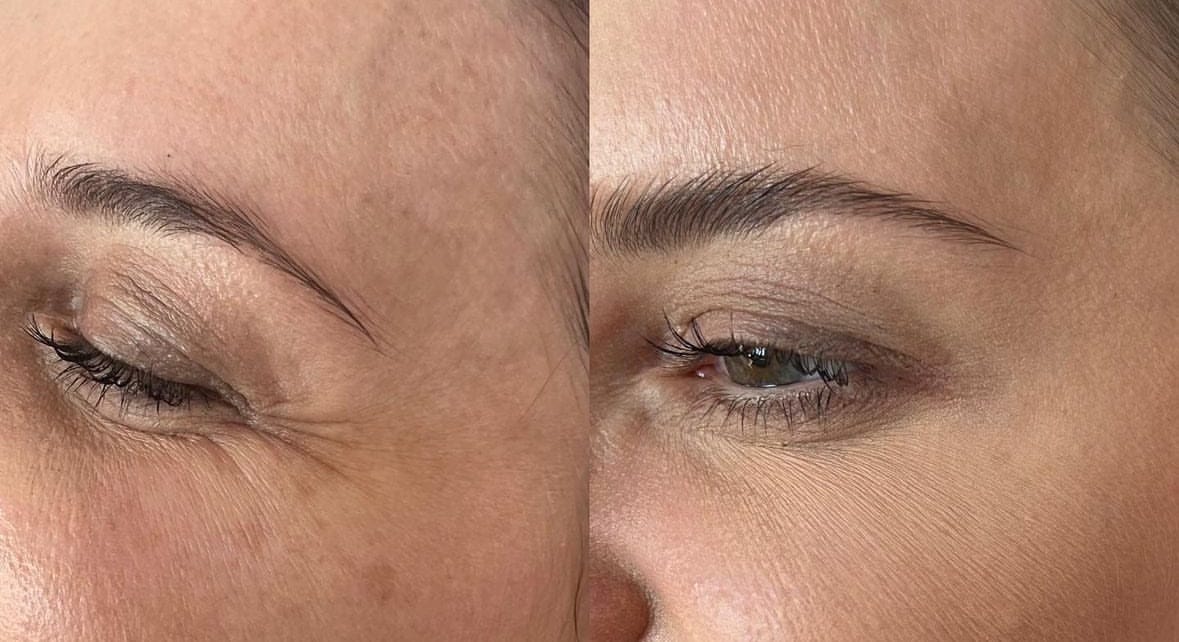 Manhattan Ice - K Beauty Micro Needle Under Eye Patches