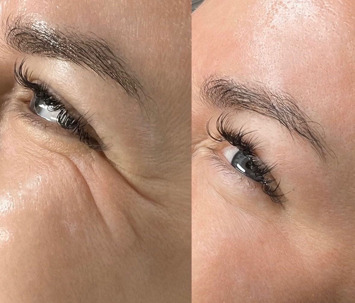 Manhattan Ice - K Beauty Micro Needle Under Eye Patches